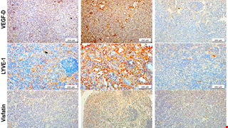 Visfatin Facilitates VEGF-D-Induced Lymphangiogenesis through Activating HIF-1α and Suppressing miR-2277-3p in Human Chondrosarcoma img