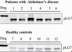 Diagnosing Alzheimer's Disease Specifically and Sensitively With pLG72 and Cystine/Glutamate Antiporter SLC7A11 AS Blood Biomarkers