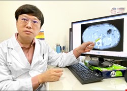 猛吞高血壓藥無效 揪出原發性高醛固酮症作祟